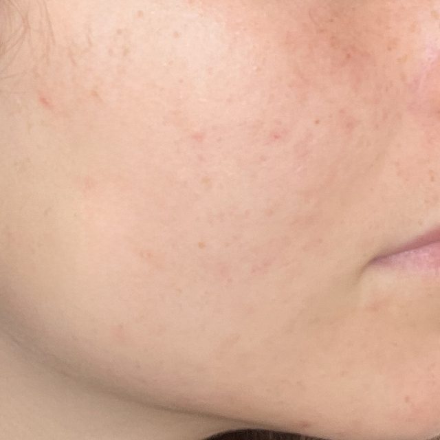 The same client's skin after treatment