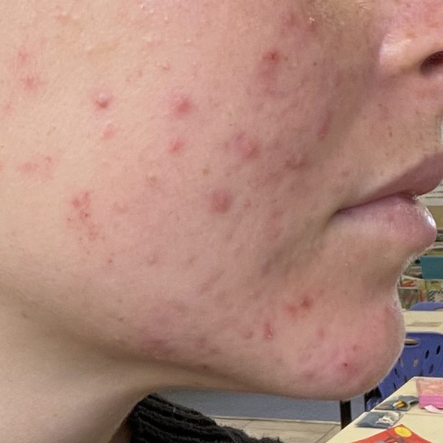 Client skin before treatment
