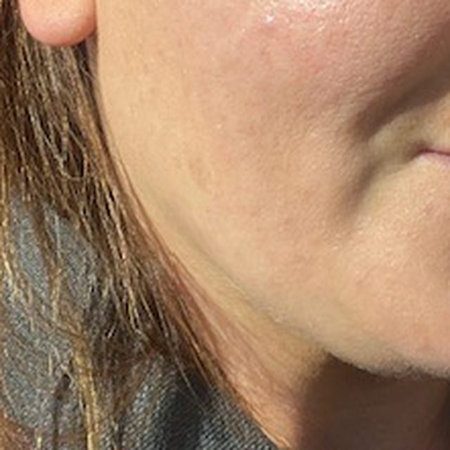 The same client's skin after treatment