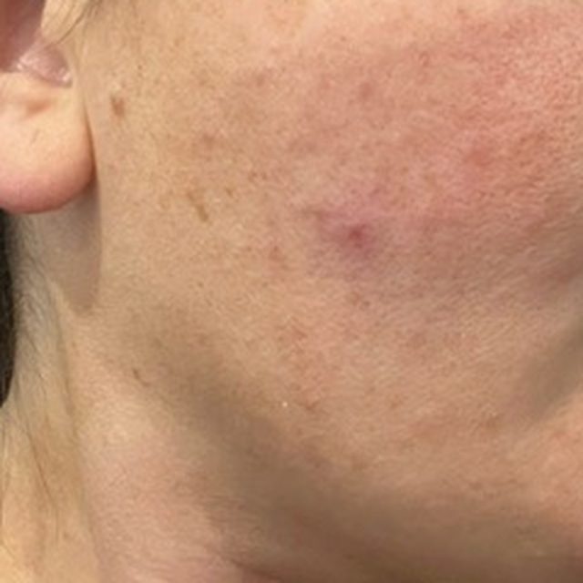 Client skin before treatment