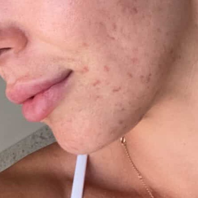 The same client's skin after treatment