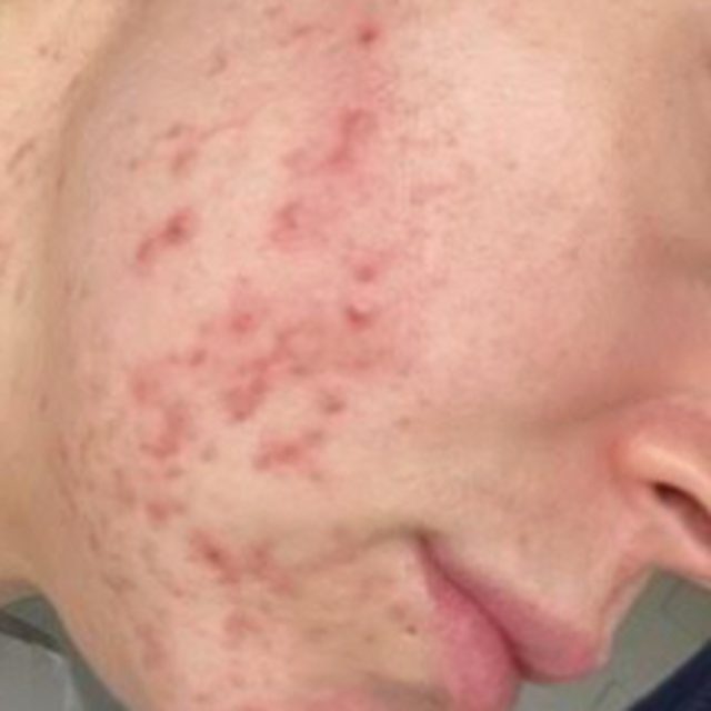 Client skin before treatment