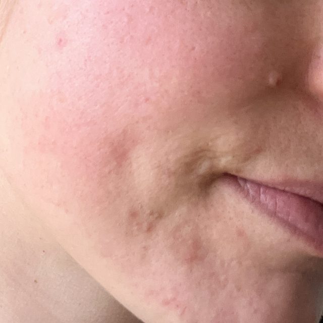 The same client's skin after treatment
