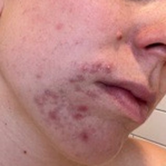 Client skin before treatment