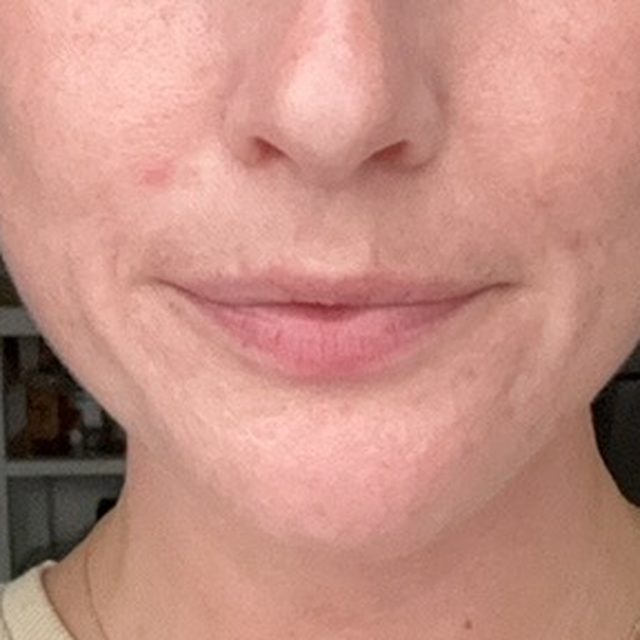 The same client's skin after treatment