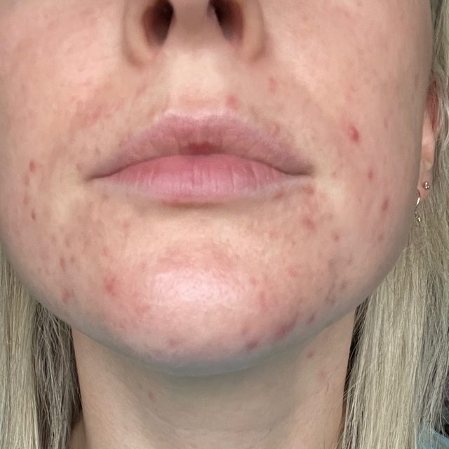 Client skin before treatment