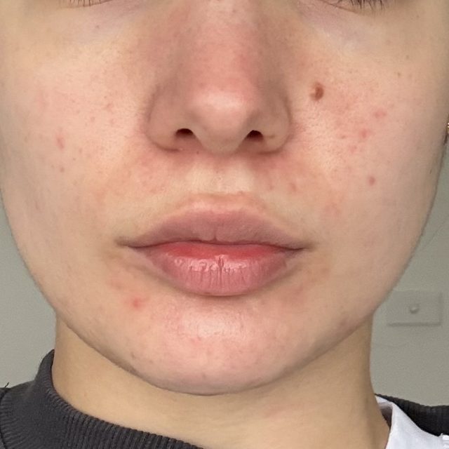 The same client's skin after treatment
