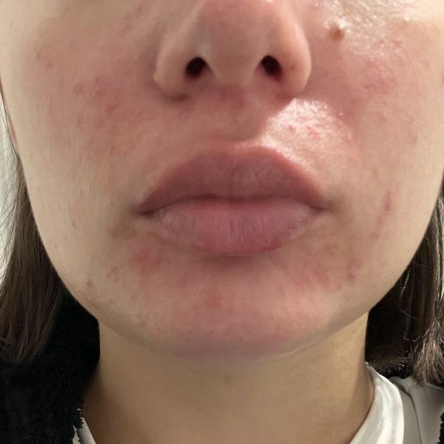 Client skin before treatment